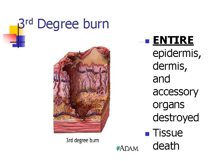 3 rd Degree burn ENTIRE epidermis, and accessory organs destroyed n Tissue death n