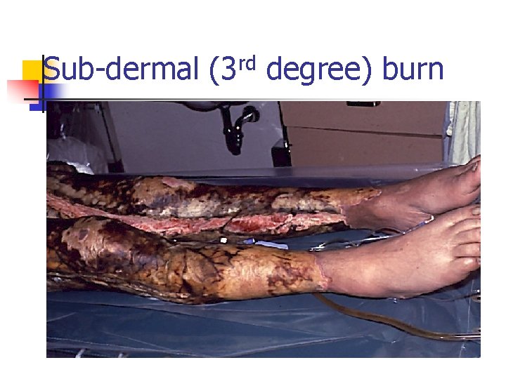 Sub-dermal (3 rd degree) burn 