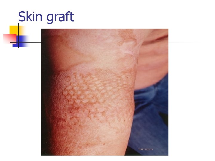 Skin graft 