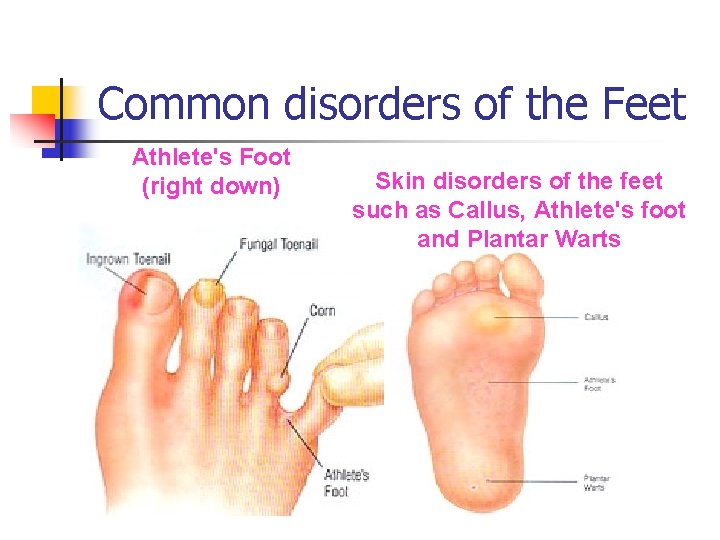 Common disorders of the Feet Athlete's Foot (right down) Skin disorders of the feet