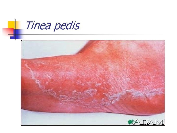 Tinea pedis 