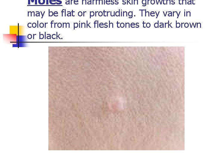 Moles are harmless skin growths that may be flat or protruding. They vary in