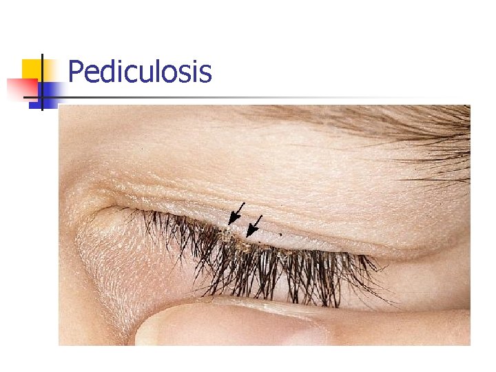 Pediculosis 