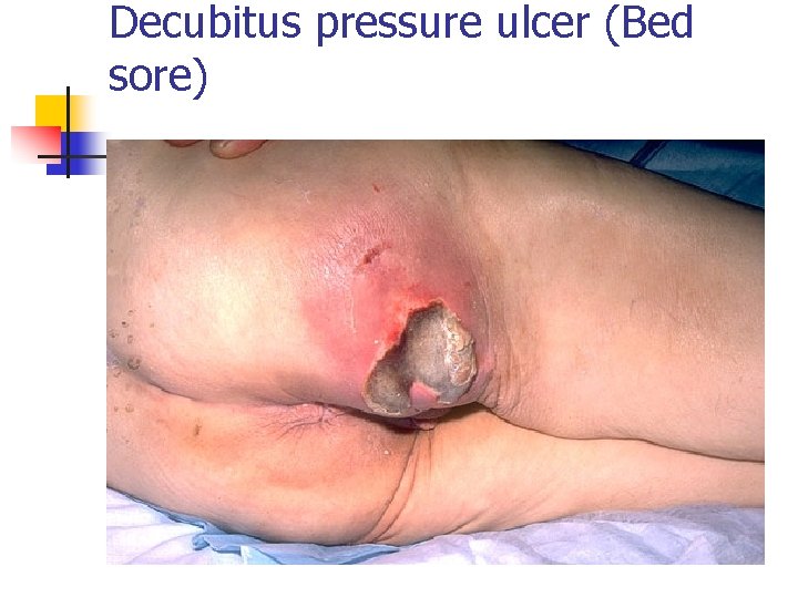 Decubitus pressure ulcer (Bed sore) 