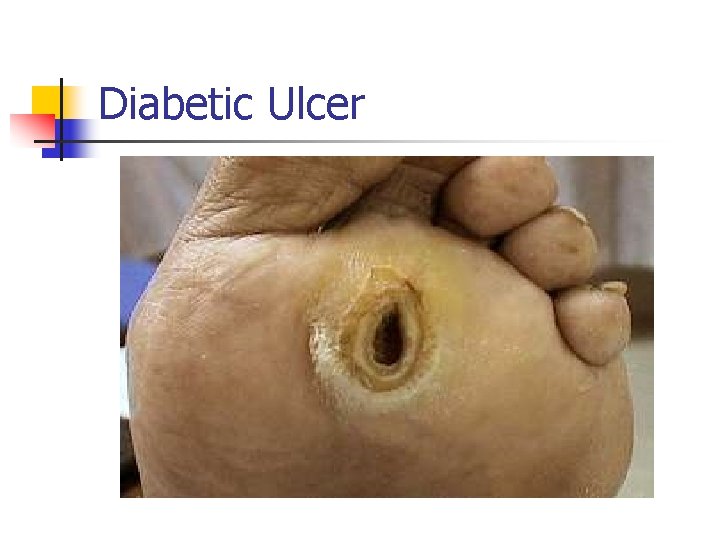 Diabetic Ulcer 