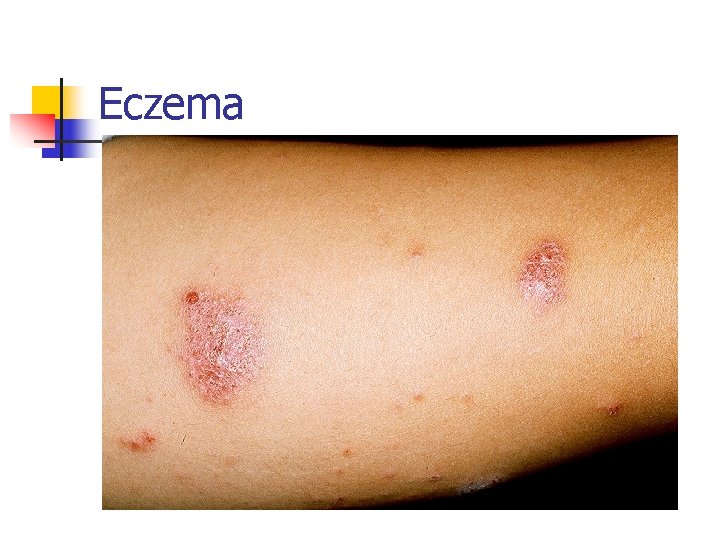 Eczema 