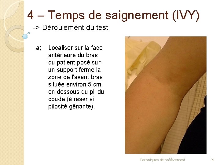 4 – Temps de saignement (IVY) -> Déroulement du test a) Localiser sur la