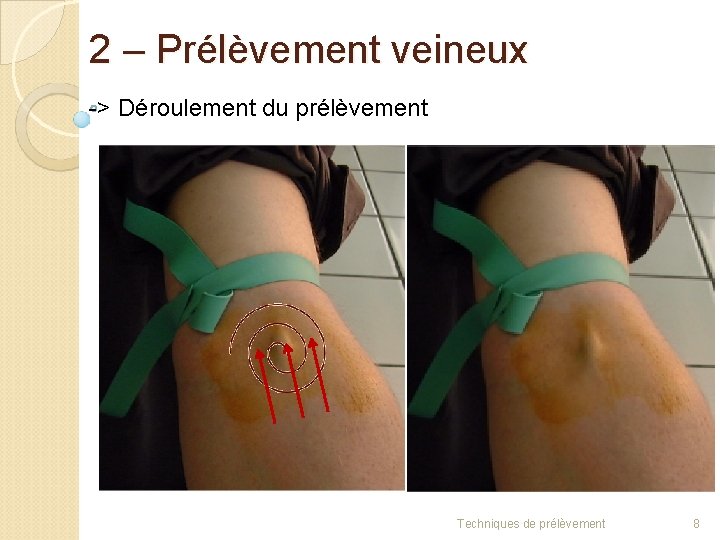 2 – Prélèvement veineux -> Déroulement du prélèvement b) Antisepsie Ø Passer sur la