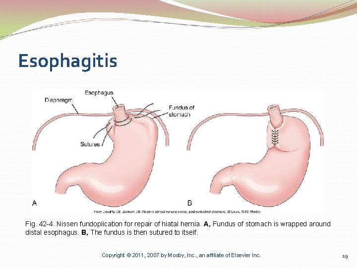 Esophagitis Fig. 42 -4. Nissen fundoplication for repair of hiatal hernia. A, Fundus of