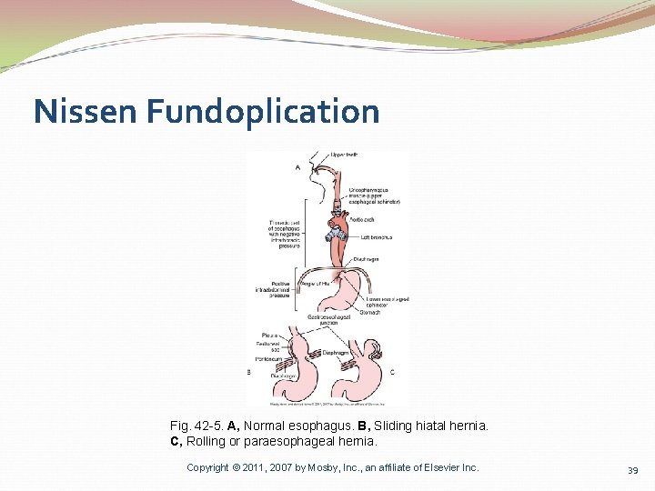 Nissen Fundoplication Fig. 42 -5. A, Normal esophagus. B, Sliding hiatal hernia. C, Rolling