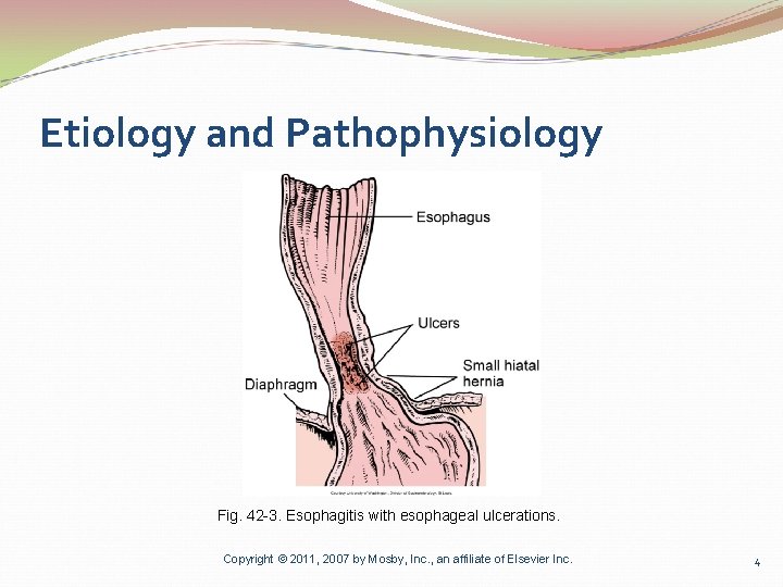 Etiology and Pathophysiology Fig. 42 -3. Esophagitis with esophageal ulcerations. Copyright © 2011, 2007