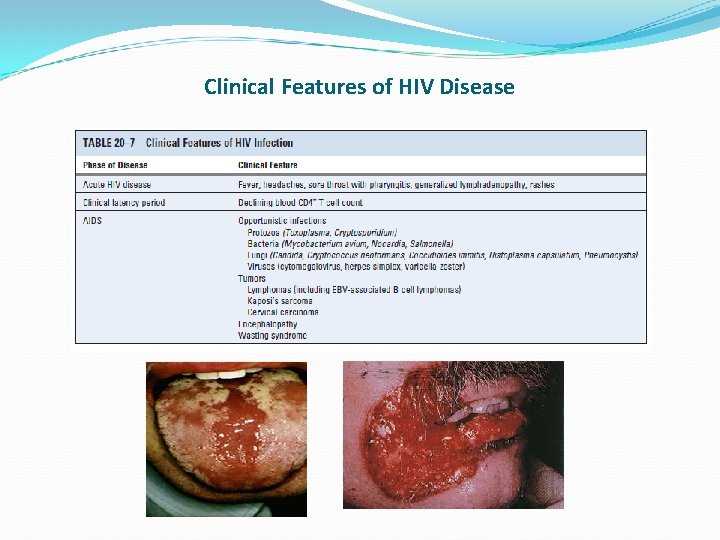 Clinical Features of HIV Disease 