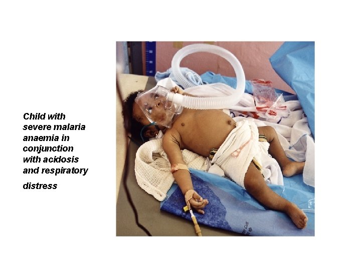 Child with severe malaria anaemia in conjunction with acidosis and respiratory distress Child with severe malaria anaemia in conjunction with acidosis and respiratory distress