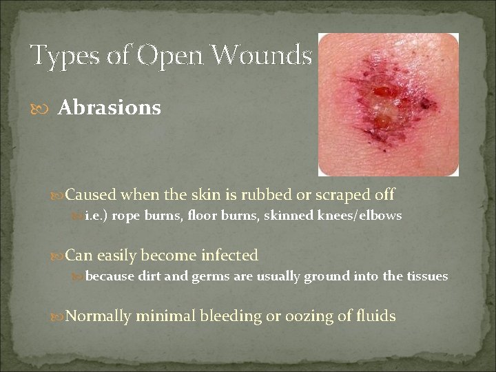 Types of Open Wounds Abrasions Caused when the skin is rubbed or scraped off
