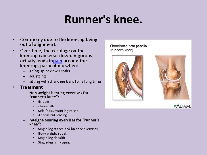 Runner's knee. • • Commonly due to the kneecap being out of alignment. Over