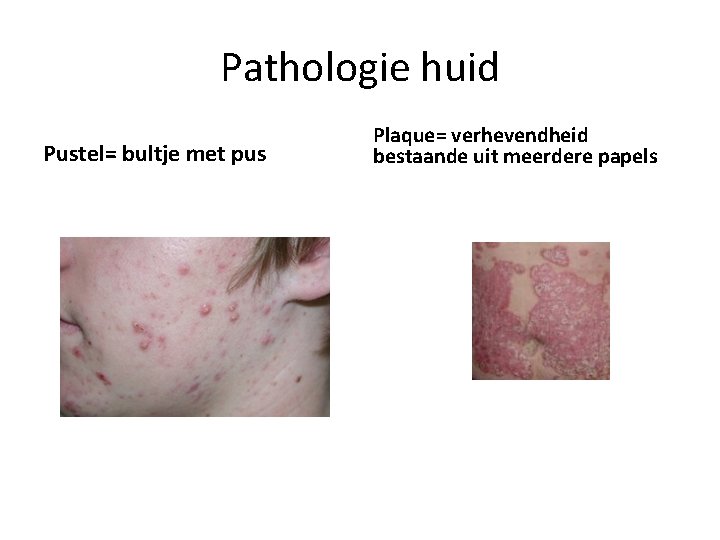 Pathologie huid Pustel= bultje met pus Plaque= verhevendheid bestaande uit meerdere papels 