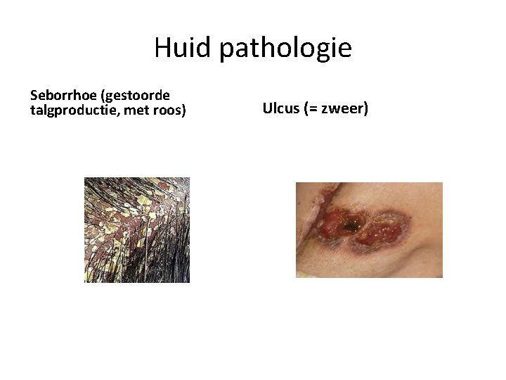 Huid pathologie Seborrhoe (gestoorde talgproductie, met roos) Ulcus (= zweer) 