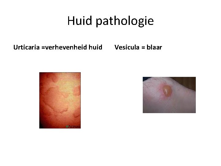 Huid pathologie Urticaria =verhevenheid huid Vesicula = blaar 