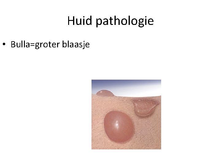 Huid pathologie • Bulla=groter blaasje 