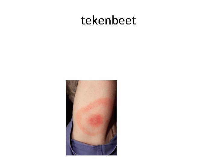 tekenbeet 