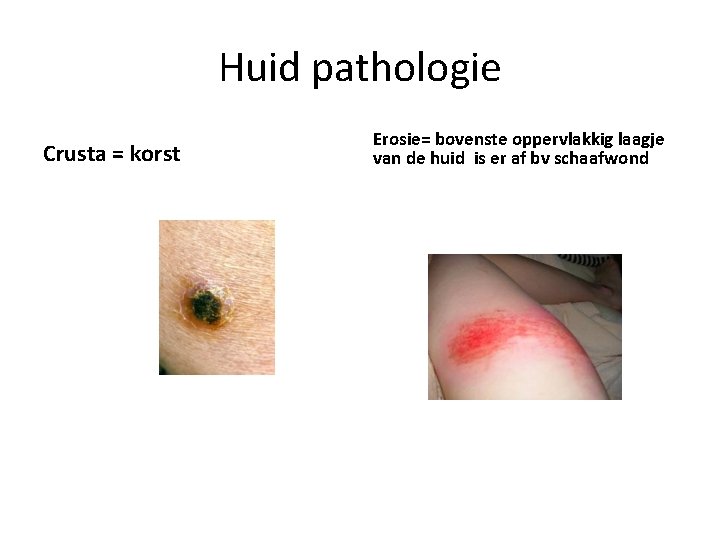 Huid pathologie Crusta = korst Erosie= bovenste oppervlakkig laagje van de huid is er