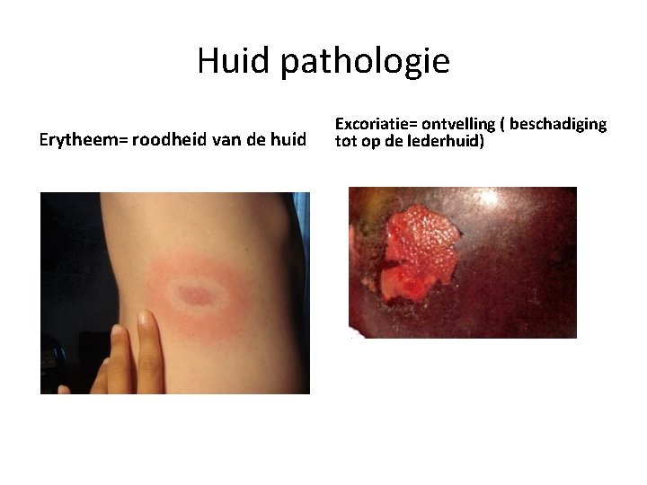 Huid pathologie Erytheem= roodheid van de huid Excoriatie= ontvelling ( beschadiging tot op de