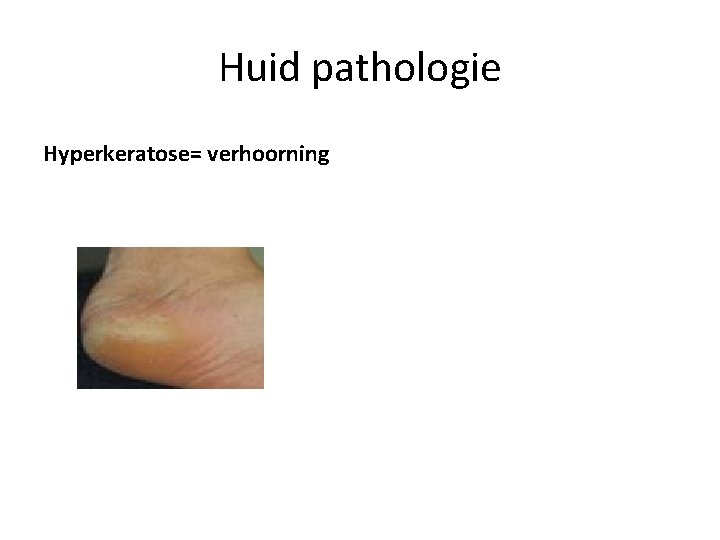 Huid pathologie Hyperkeratose= verhoorning 