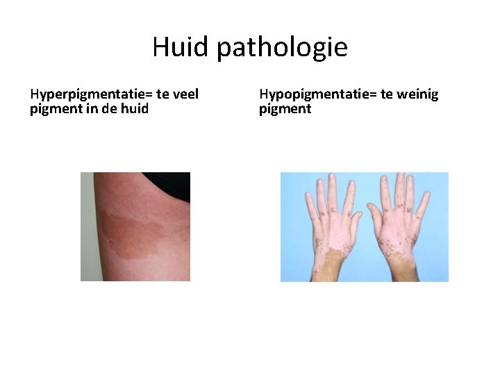 Huid pathologie Hyperpigmentatie= te veel pigment in de huid Hypopigmentatie= te weinig pigment 