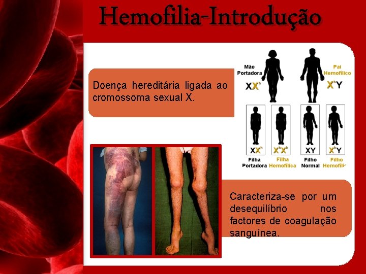 Hemofilia-Introdução Doença hereditária ligada ao cromossoma sexual X. Caracteriza-se por um desequilíbrio nos factores