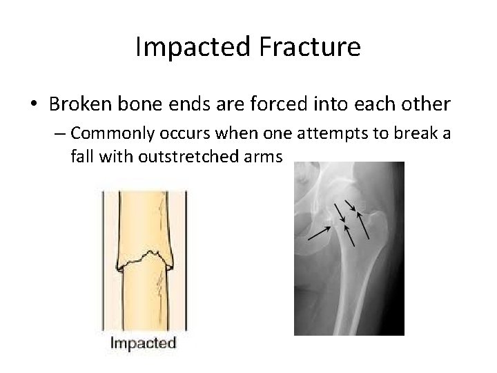 Impacted Fracture • Broken bone ends are forced into each other – Commonly occurs