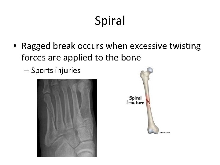 Spiral • Ragged break occurs when excessive twisting forces are applied to the bone