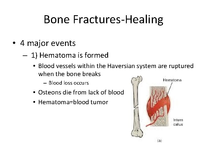 Bone Fractures-Healing • 4 major events – 1) Hematoma is formed • Blood vessels
