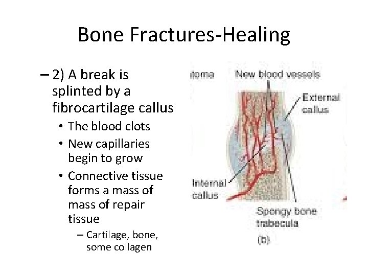 Bone Fractures-Healing – 2) A break is splinted by a fibrocartilage callus • The