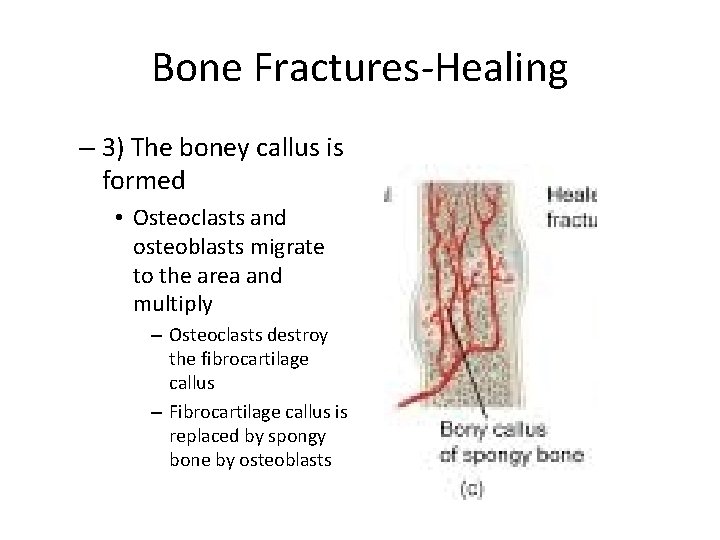 Bone Fractures-Healing – 3) The boney callus is formed • Osteoclasts and osteoblasts migrate