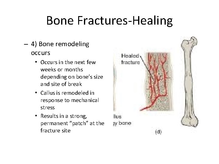 Bone Fractures-Healing – 4) Bone remodeling occurs • Occurs in the next few weeks