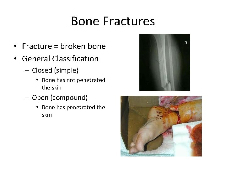 Bone Fractures • Fracture = broken bone • General Classification – Closed (simple) •
