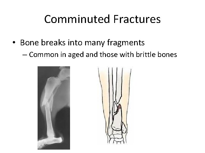 Comminuted Fractures • Bone breaks into many fragments – Common in aged and those