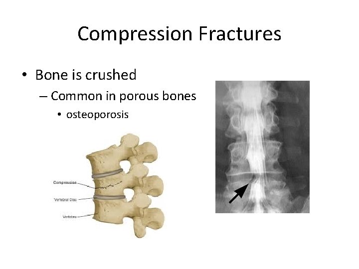 Compression Fractures • Bone is crushed – Common in porous bones • osteoporosis 
