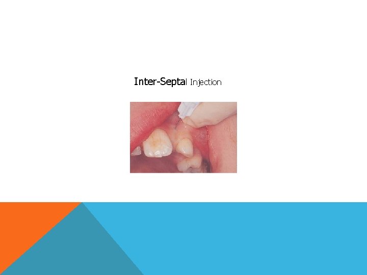 LOCAL ANALGESIA Painful procedures are the most important