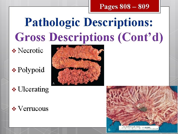 Pages 808 – 809 Pathologic Descriptions: Gross Descriptions (Cont’d) v Necrotic v Polypoid v