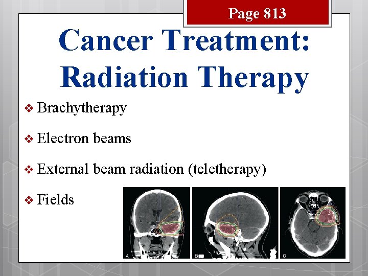 Page 813 Cancer Treatment: Radiation Therapy v Brachytherapy v Electron beams v External beam