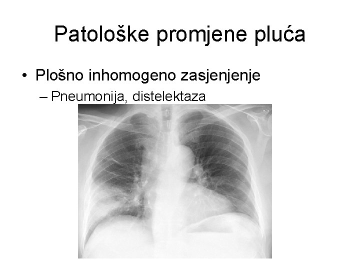 Patološke promjene pluća • Plošno inhomogeno zasjenjenje – Pneumonija, distelektaza 
