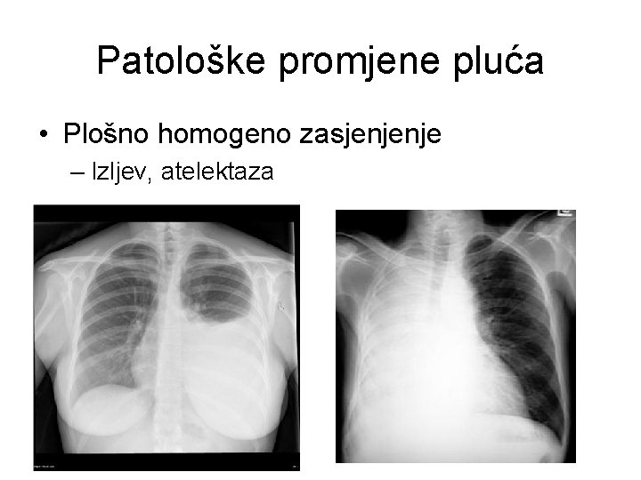 Patološke promjene pluća • Plošno homogeno zasjenjenje – Izljev, atelektaza 