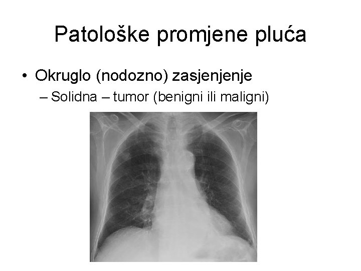 Patološke promjene pluća • Okruglo (nodozno) zasjenjenje – Solidna – tumor (benigni ili maligni)