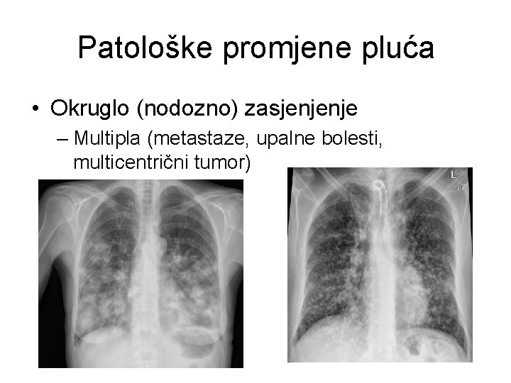 Patološke promjene pluća • Okruglo (nodozno) zasjenjenje – Multipla (metastaze, upalne bolesti, multicentrični tumor)