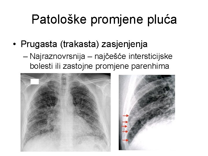 Patološke promjene pluća • Prugasta (trakasta) zasjenjenja – Najraznovrsnija – najčešće intersticijske bolesti ili