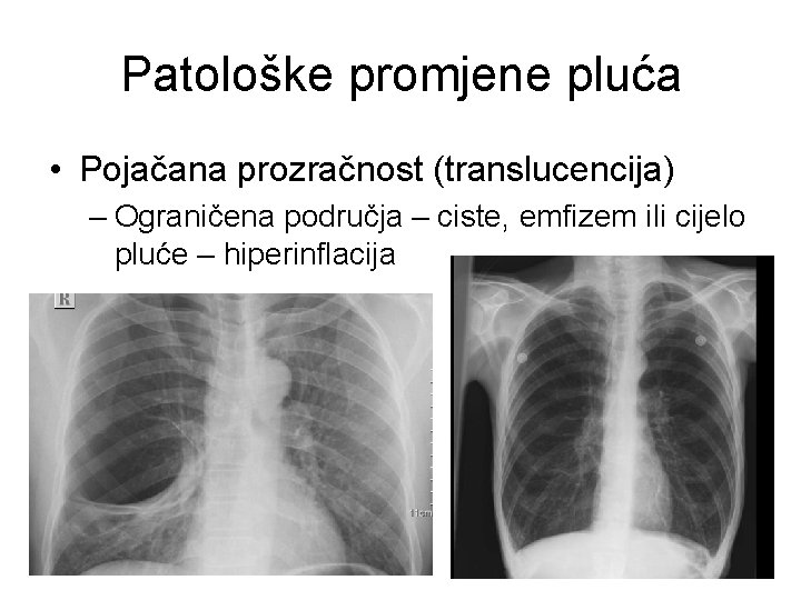 Patološke promjene pluća • Pojačana prozračnost (translucencija) – Ograničena područja – ciste, emfizem ili