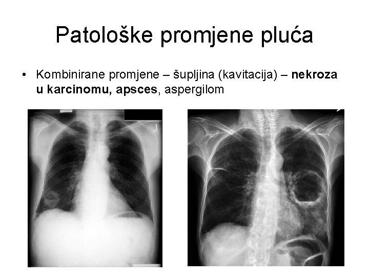 Patološke promjene pluća • Kombinirane promjene – šupljina (kavitacija) – nekroza u karcinomu, apsces,