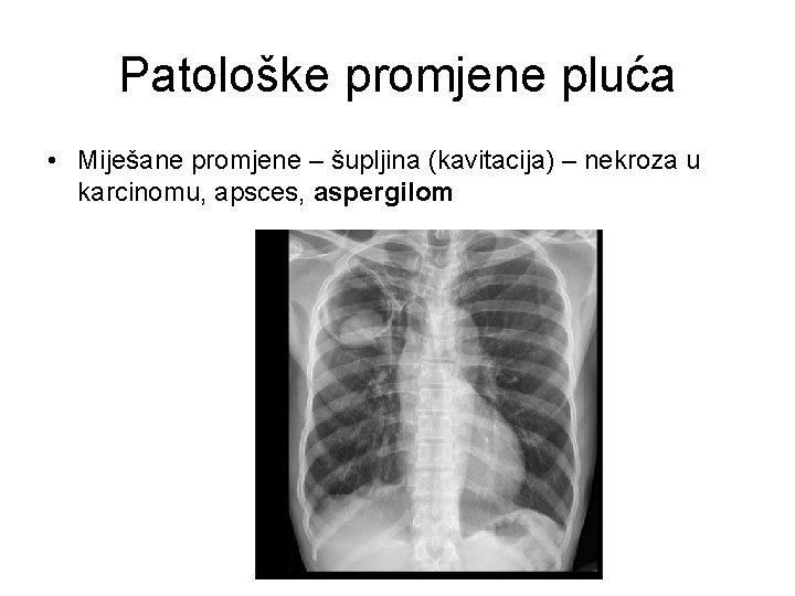 Patološke promjene pluća • Miješane promjene – šupljina (kavitacija) – nekroza u karcinomu, apsces,