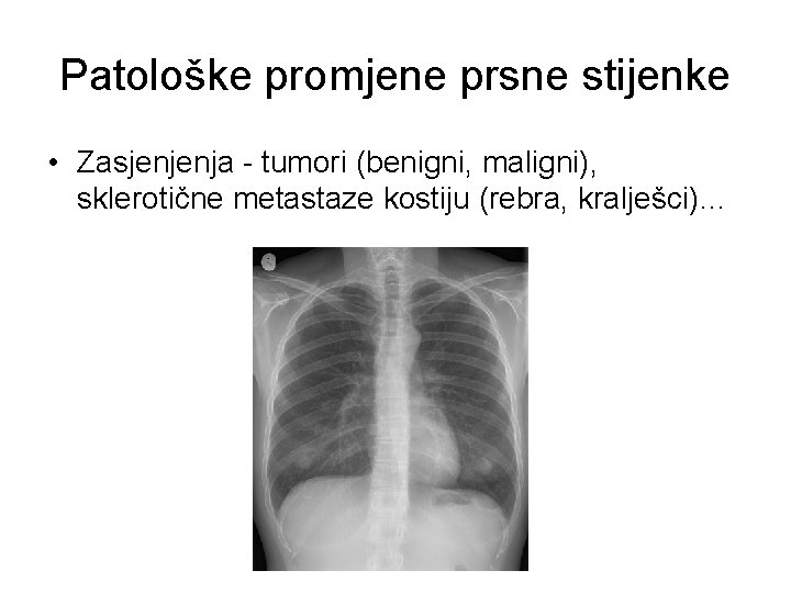 Patološke promjene prsne stijenke • Zasjenjenja - tumori (benigni, maligni), sklerotične metastaze kostiju (rebra,